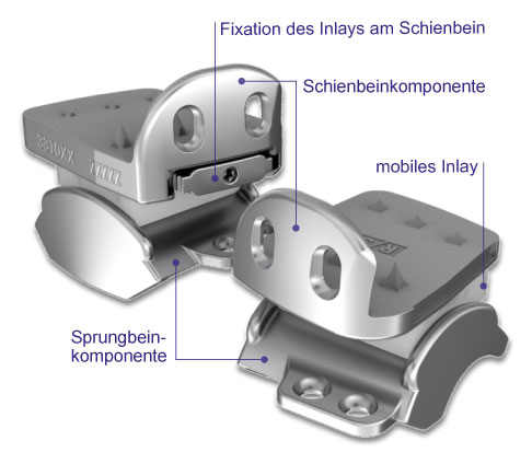 2-Komponenten-Sprunggelenksprothese mit fixiertem Inlay links. Rechts ist die 3-Komponenten-Sprunggelenksprothese abgebildet. Sie besitzt mit dem mobilem Inlay zusätzlich zur Schienbein- und Sprungbeinkomponente eine eigenständige dritte Komponente. Sprunggelenksprothesen Abbildung