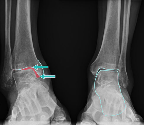 Bei dieser Varusarthrose ist es zu einem Defekt am Innenknöchel gekommen. Hier muss eine individuelle Behandlungsstrategie erstellt werden, z. B. mit Implantation einer Sprunggelenksprothese. © Gelenk-Klinik Behandlung von Varusarthrose