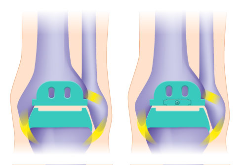Rechts eine Zwei-Komponenten-Prothese mit fixiertem Inlay, links eine Drei-Komponenten-Prothese mit mobilem Inlay. © Gelenk-Klinik Rechts eine Zwei-Komponenten-Prothese mit fixiertem Inlay, links eine Drei-Komponenten-Prothese mit mobilem Inlay.