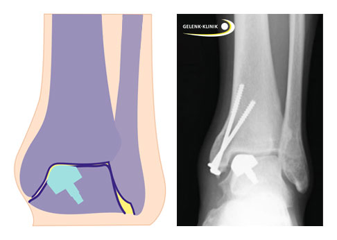 Implantation einer Teilprothese im Sprungbein über eine Osteotomie im Bereich des Innenknöchels. Die beiden Schrauben im Röntgenbild refixieren den abgelösten Innenknöchel des Schienbeins nach der Osteotomie © Gelenk-Klinik Implantation einer Teilprothese im Sprungbein über eine Osteotomie im Bereich des Innenknöchels.