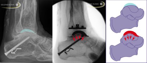 Röntgenbild vor der Operation (links): Durch Arthrose hat sich das Sprungbein verformt (türkis markiert). Röntgenbild nach der Operation mit Sprunggelenksprothese (Mitte). Die Prothese stellt die normale Form des Sprungbeins (Talus) wieder her und gewährleistet eine gleichmäßige Kraftverteilung ohne Kanten und Ecken (rote Pfeile). © Gelenk-Klinik OSG-TEP OP Verlauf