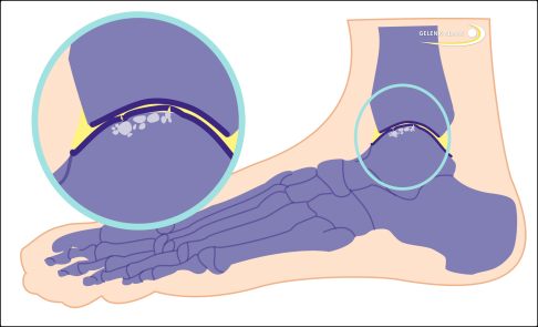 Schematische Darstellung des arthrotisch veränderten Sprungbeins. Die Knorpelschicht (dunkelblau) ist geschädigt und der darunterliegende Knochen ist erweicht (weiße Bereiche). © Gelenk-Klinik Schematische Darstellung des arthrotisch veränderten Sprungbeins.