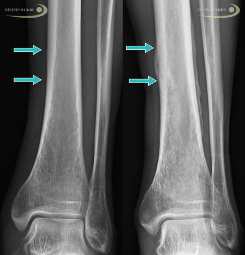 Stressfraktur der Tibia
