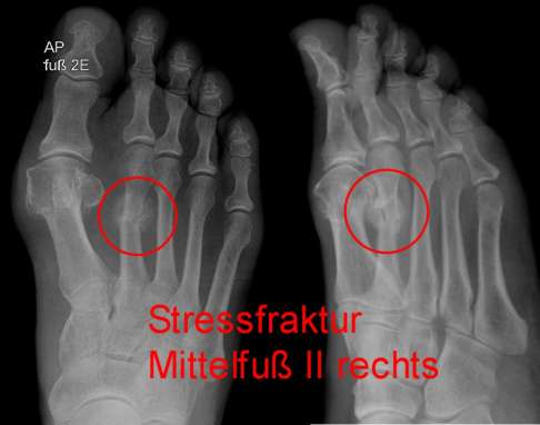 Röntgenbild eines Ermüdungsbruchs (Stressfraktur) am 2. Zehenstrahl der Mittelfußknochen (Metatarsalia) eines Laufsportlers. © Gelenk-Klinik Röntgenbild eines Ermüdungsbruchs