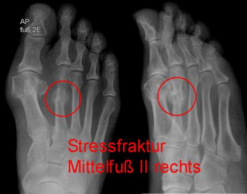 Röntgenbild: Ermüdungsbruch des Mittelfußknochens