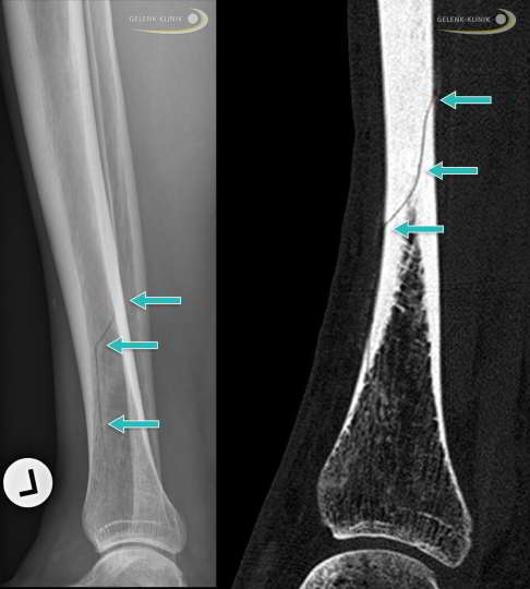 Stressfraktur der Tibia