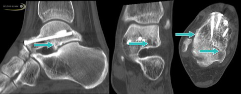 CT-Bild eines Talus nach Stabilisierung mithilfe von Schrauben, mit denen die Talushalsfraktur operativ versorgt wurde. Rechts ist noch die ehemalige Bruchlinie zu erkennen, die mithilfe von Schrauben stabilisiert (reponiert) wurde. Die Stellung der Knochenfragmente nach der Fraktur ist in allen drei gezeigten Ebenen nach der Operation sehr gut. Die in der Mitte sichtbaren, kleinen dunklen Flecken entsprechen einer partiellen Nekrose, die sich im Verlauf der Heilung nicht vergrößerte. Bei diesem Patienten verlor der Talus durch die Nekrose keine Stabilität. Die Teilnekrosen verursachten kaum Beschwerden. © Dr. Thomas Schneider CT-Bild einer Talus-Nekrose