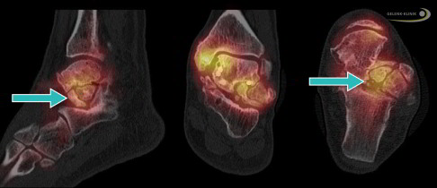 Das Spect-CT hilft, die nekrosebedingte Veränderungen des Knochenstoffwechsels zu beurteilen. Dies ist besonders hilfreich, um je nach Stadium der Talusnekrose die Ursache für Schmerzen und die aktuellen Prozesse im Knochen besser zu verstehen. Im SPECT ist zu sehen, dass die Nekrose mit Kollaps (Zusammenbruch) des Sprungbeins weit weniger Aktivität verursacht – erkennbar an der gelb dargestellten Anreicherung des radioaktiven Markers – als im gleichen Bild die Arthrose im oberen Sprunggelenk am inneren Sprungbein und Innenknöchel. © Dr. Thomas Schneider SPECT-CT bei Talusnekrose
