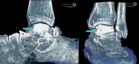 DVT-Bild eines Taluskollaps infolge einer Talusnekrose: Das Knochensterben vermindert die Tragfähigkeit des Talus entscheidend. Der Knochen kann deshalb bei einer eigentlich unkritischen Belastung kollabieren. Nach dem Kollaps erfolgt eine Verdichtung des abgestorbenen Knochens, Stressfrakturen mit Verformung des Sprungbeins und Auflösung von Knochenanteilen im Sprungbein. Durch die nach einer Stressfraktur auftretenden Stufen im unteren und oberen Sprunggelenk entsteht Arthrose. Dieser Verschleiß verstärkt die Beschwerden. Der Pfeil zeigt auf den stark sklerosierten Knochenbezirk im Talus. © Dr. Thomas Schneider Taluskollaps mit Verdichtung des abgestorbenen Knochens