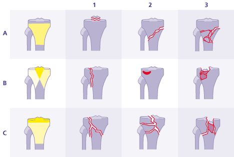 Klassifikation der Arbeitsgemeinschaft für Osteosynthesefragen (AO) für proximale Tibiakopfbrüche. Kategorie A: Die Gelenkfläche des Schienbeins ist nicht betroffen. Kategorie B: Die Gelenkfläche ist teilweise betroffen. Kategorie C: Die Gelenkfläche ist vollständig betroffen. Der Schweregrad der Fraktur steigt von 1 bis 3. Bei B1 liegt beispielsweise ein Spaltbruch vor, bei B2 ein Eindrückungsbruch, bei B3 ein Spalt-Impressionsbruch. © Gelenk-Klinik Schematische Übersicht: AO-Klassifikation Tibiakopfbrüche A, B, C.