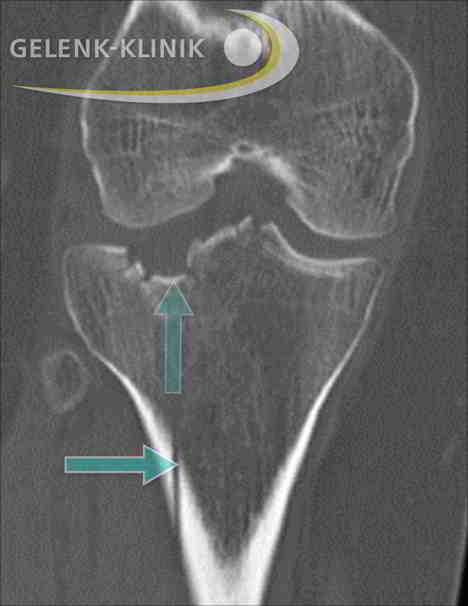 Tibiakopffraktur mit kombiniertem Spalt- und Eindrückungsbruch.
