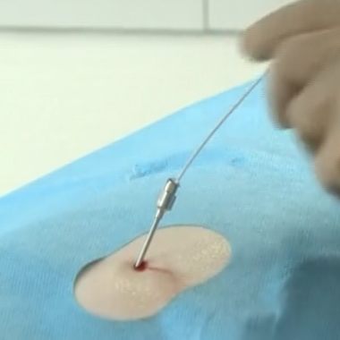 Die PASHA-Elektrode wird durch eine Kanüle in den Spinalkanalstenose (Wirbelkanal) eingeführt.© omar-pasha.com Die PASHA-Elektrode wird durch eine Kanüle in den Spinalkanalstenose (Wirbelkanal) eingeführt. © omar-pasha.com