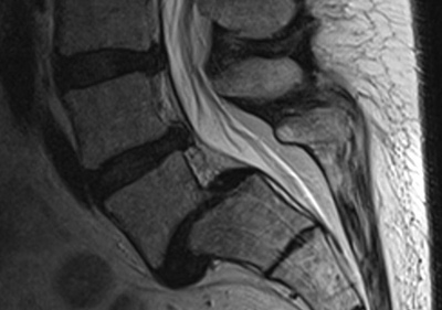 Seitliche MRT-Aufnahme einer Spondylolisthesis der Lendenwirbelsäule. Deutlich sichtbar ist die Stufenbildung zwischen den Wirbeln. © Gelenk-Klinik MRT einer Spondylolisthese (Wirbelgleiten)