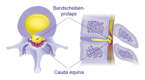 Cauda-equina-Syndrom durch Bandscheibenprolaps. Die Einengung der Nervenfasern der Cauda equina durch den vorgefallenen Bandscheibenkern sind im Querschnitt (linke Abbildung) und von der Seite gesehen (rechte Abbildung) gut zu erkennen. © Gelenk-Klinik Bandscheibenprolaps Cauda equina