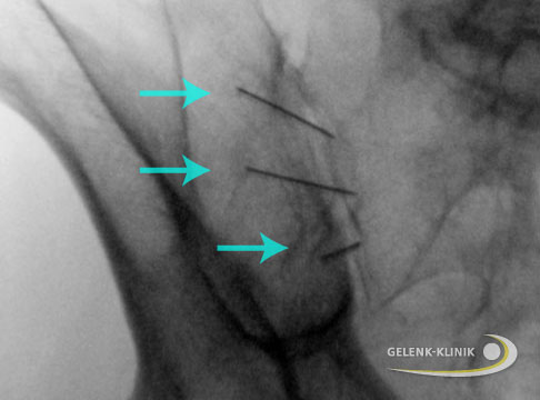 Infiltration bei einem Patienten mit Schmerzen im Iliosakralgelenk (ISG-Syndrom). Zu sehen sind in diesem Röntgenbild drei Hohlnadeln (blaue Pfeile), deren Spitzen am Kreuzdarmbeingelenk enden. Durch sie lassen sich schmerzstillende und entzündungshemmende Medikamente direkt an das ISG-Gelenk spritzen. © Gelenk-Klinik Infiltrationstherapie der Iliosakralgelenke