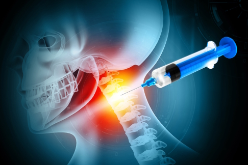 In manchen Fällen kann man eine Radikulopathie durch die interventionelle Schmerztherapie lindern. Dabei spritzt der Arzt unter Röntgenkontrolle ein Gemisch aus Kortison und Betäubungsmitteln in die Nähe der gereizten Nervenwurzel. © Crystal light, Adobe Interventionelle Schmerztherapie an der Halswirbelsäule