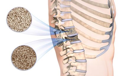 Eine Osteoporose schwächt die Knochensubstanz des Wirbelkörpers, sodass dieser einbrechen kann. Man spricht dann von einer Sinterung. © Sagittaria, Fotolia Wirbelkörperfraktur durch Osteoporose