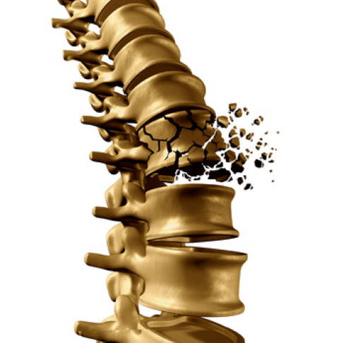 Wird das Knochengewebe im Wirbelkörper durch Osteoporose instabil, können harmlose Alltagssituationen zu einem Wirbelkörperbruch führen. Dabei kollabiert der Knochen und die Höhe des Wirbels vermindert sich. © freshidea, Fotolia Wirbelkörperbruch durch Osteoporose