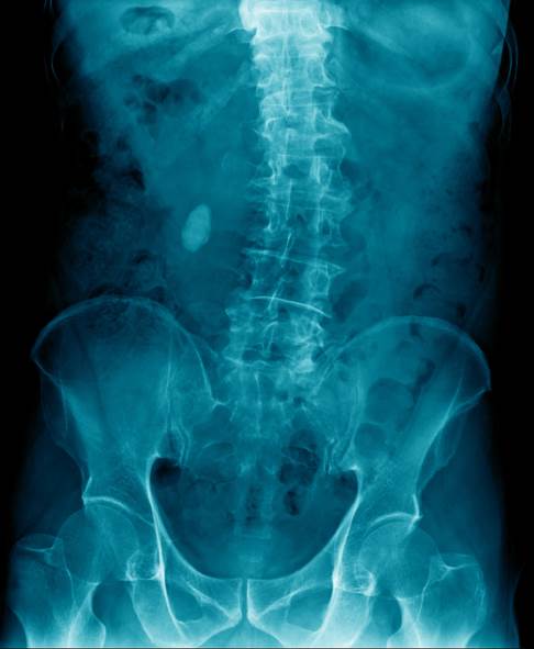 Thorakolumbale Skoliose im Röntgenbild: Die Verkrümmung betrifft den Bereich zwischen Brust- und Lendenwirbelsäule. © angkhan, Fotolia Röntgenbild einer Skoliose