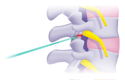 Darstellung einer Facettengelenksinfiltration. Das schmerzstillende Medikament wird über die eingeführte Hohlnadel (grün) direkt an die arthrotischen Facettengelenke (rot) gespritzt (grau: Wirbelkörper, gelb: austretende Spinalnerven, rosa: Bandscheiben). © Gelenk-Klinik Infiltration eines Facettengelenks