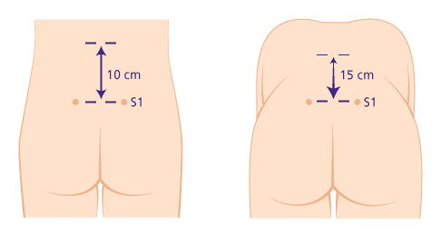Bei normaler Beweglichkeit sollte sich der Abstand zwischen den beiden Markierungen in der Beugung um mindestens 5 cm verlängert haben. © Gelenk-Klinik Schober-Test zur Feststellung eines Morbus Bechterew