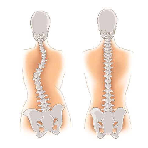 Beckenschiefstand bei Skoliose