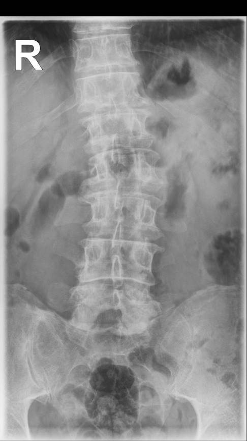 Röntgenbild einer linkskonvexen Lumbalskoliose © Gelenk-Klinik linkskonvexe lumbale Skoliose
