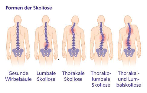 Die Höhe der Hauptkrümmung bestimmt, um welche Form der Skoliose es sich handelt. © Gelenk-Klinik Formen der Skoliose