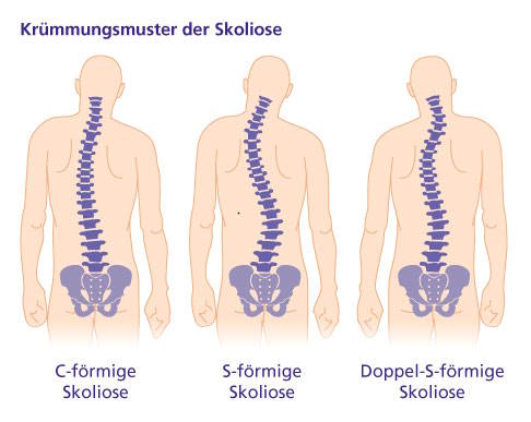 Man unterscheidet drei Krümmungsmuster der Skoliose: die C-Form, die S-Form und die Doppel-S-Form (Triple-Skoliose). © Gelenk-Klinik Krümmungsmuster der Skoliose