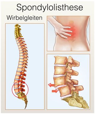 Eine Spondylolisthesis (Wirbelgleiten) entsteht häufig durch Verschleißprozesse in der Lendenwirbelsäule. Die Wirbelsäule wird instabil und Betroffene leiden unter starken Rückenschmerzen. © Henrie, Fotolia Spondylolisthese (Wirbelgleiten)