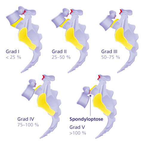 Die Spondylolisthesis wird in 5 Schweregrade nach Meyerding eingeteilt. © Gelenk-Klinik Klassifikation des Wirbelgleitens nach Meyerding