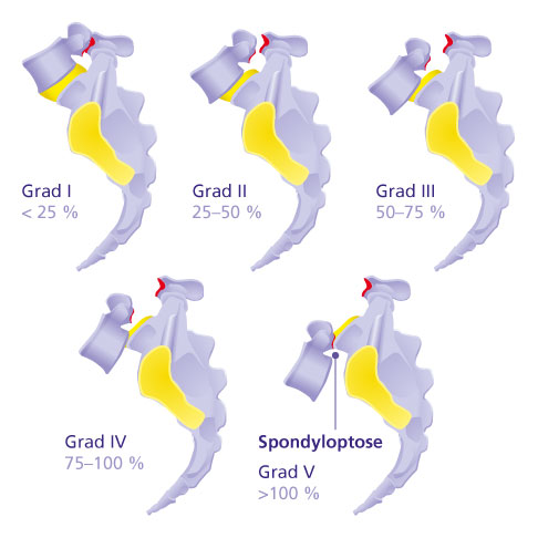 Schweregrade des Wirbelgleitens mit Spondyloptose